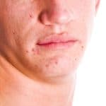 Here are three less traditional ways to deal with acne.