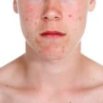 There are a range of options available to help treat and manage acne, including the Omnilux Acne Treatment approach, which is available at Skin Solutions.