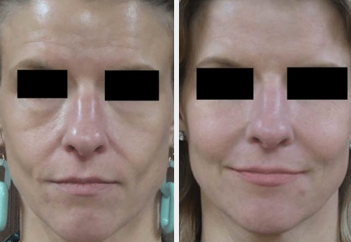 juvederm before and after | Raleigh